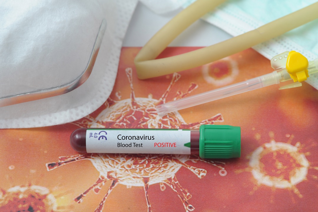 coronavirus 7528 test sierologici