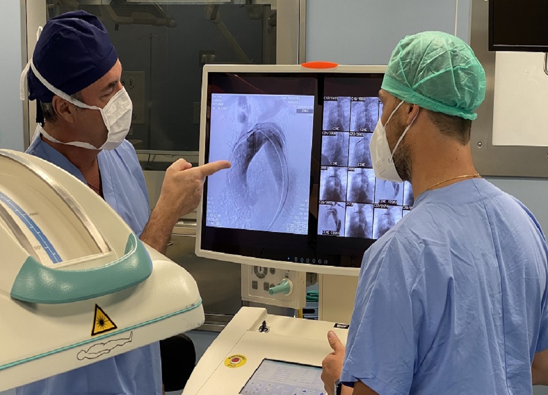 A Monza corretto un grande aneurisma dell’aorta con una tecnica mininvasiva