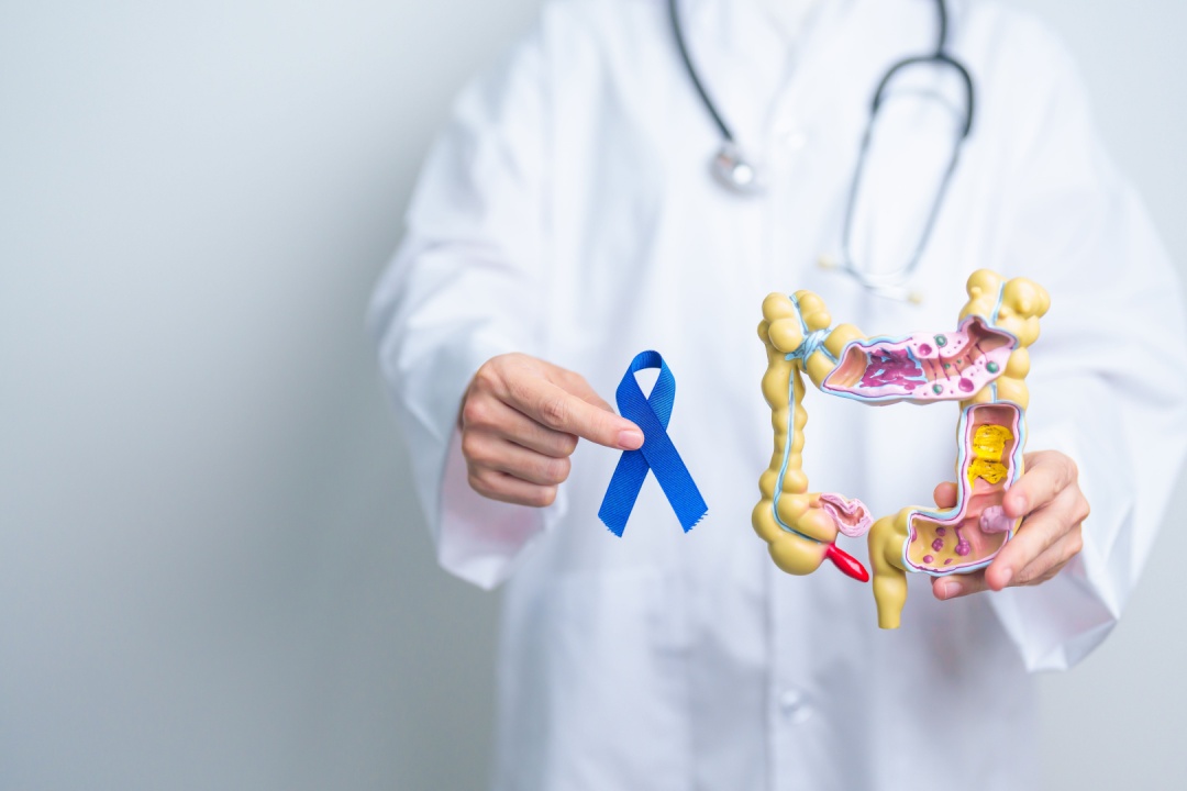 Screening colon retto
