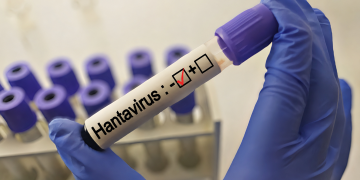 Gli esami sul paziente inglese contatto di Hantavirus hanno dato esito negativo, è in quarantena al Sacco a Milano
