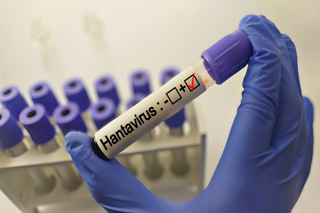 Gli esami sul paziente inglese contatto di Hantavirus hanno dato esito negativo, è in quarantena al Sacco a Milano