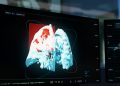 Salute, nodulo al Polmone Video shutterstock 30102026